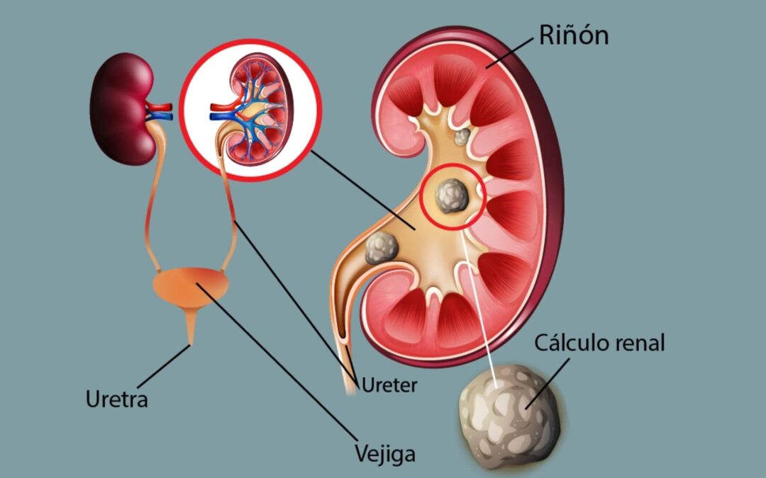 10 formas de aliviar cálculos renales